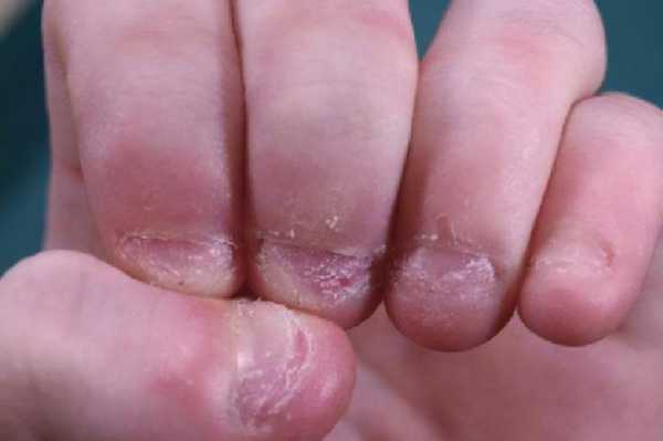 咬指甲治疗方案 严重咬指甲指甲修复-图3