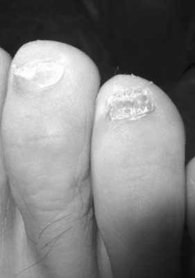 灰色厚脚指甲怎么修复-图3