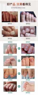 指甲修复液使用前后对比图-图1